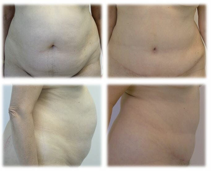 Abdominoplasty (Tummy Tuck) by Dr. Thomassen
