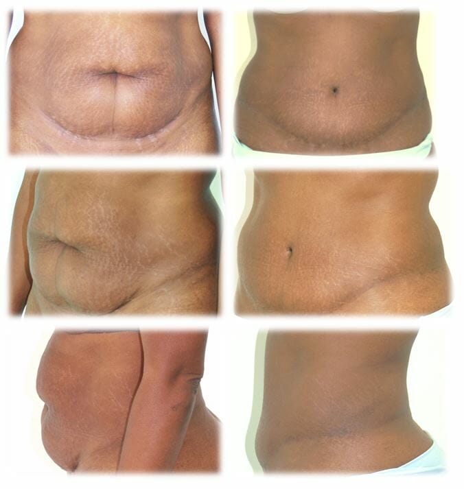 Abdominoplasty (Tummy Tuck) by Dr. Thomassen