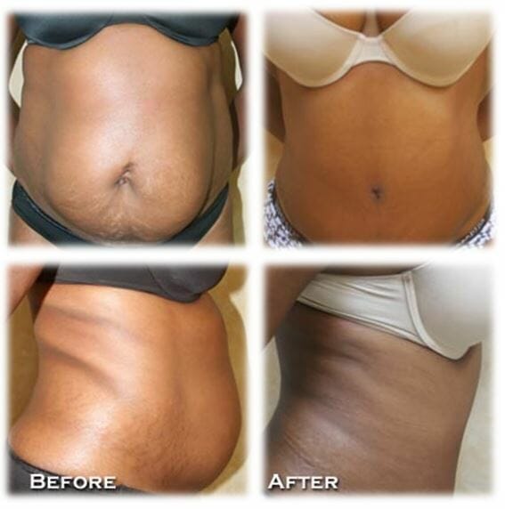 Abdominoplasty (Tummy Tuck) by Dr. Thomassen
