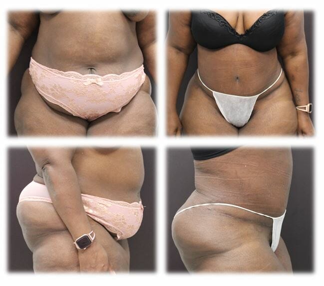 Abdominoplasty (Tummy Tuck) by Dr. Thomassen