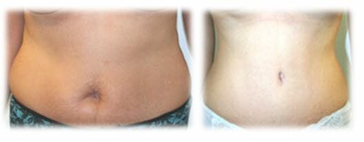 Abdominoplasty (Tummy Tuck) by Dr. Thomassen