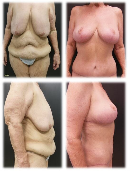 Circumferential Abdominoplasty and Breast Lift by Dr. Thomassen