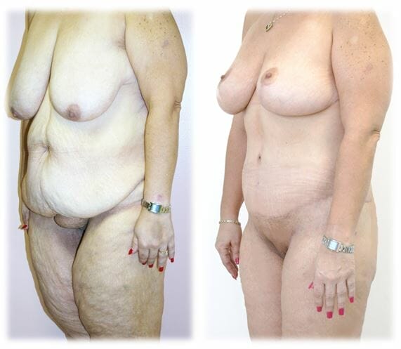 Weight Loss Body Contouring2 Circumferential Abdominoplasty and Breast Lift by Dr. Thomassen
