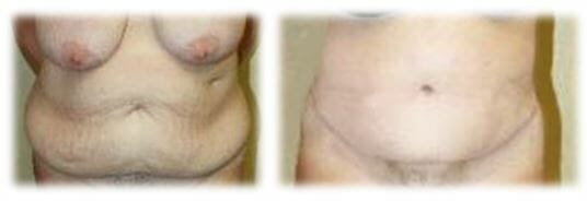 Circumferential Abdominoplasty by Dr. Thomassen