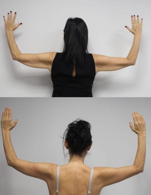 Brachioplasty by Dr. Thomassen