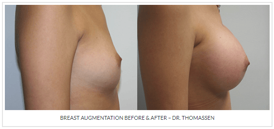 Breast Augmentation by Dr. Thomassen