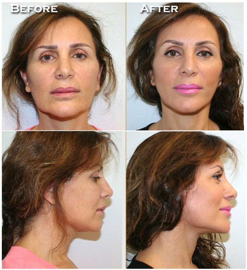 Facelift 3 facelift before and after, by Dr. Thomassen in Fort Lauderdale