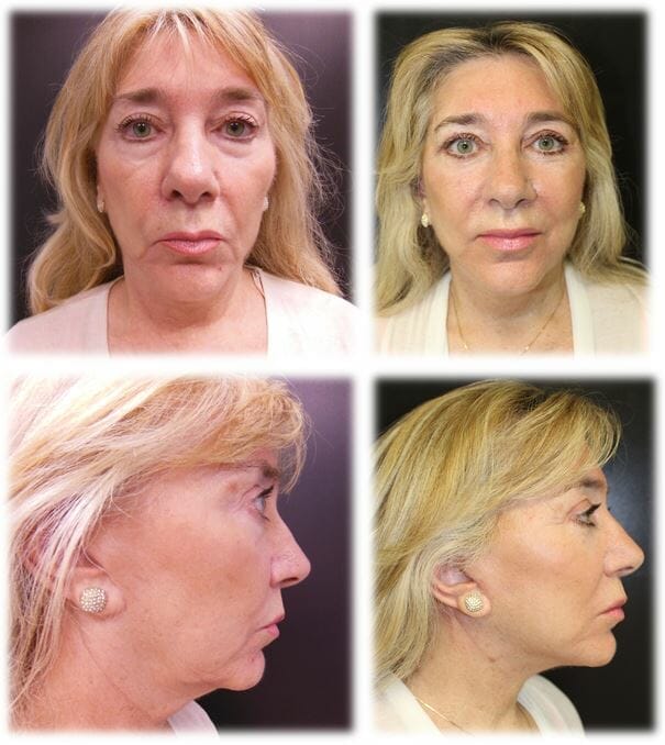 facelift40 facelift before and after fort lauderdale