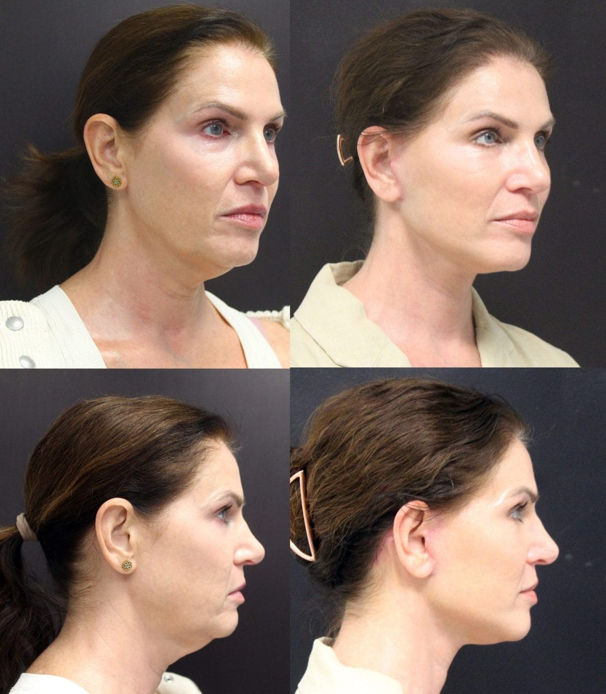 facelift before and after fort lauderdale