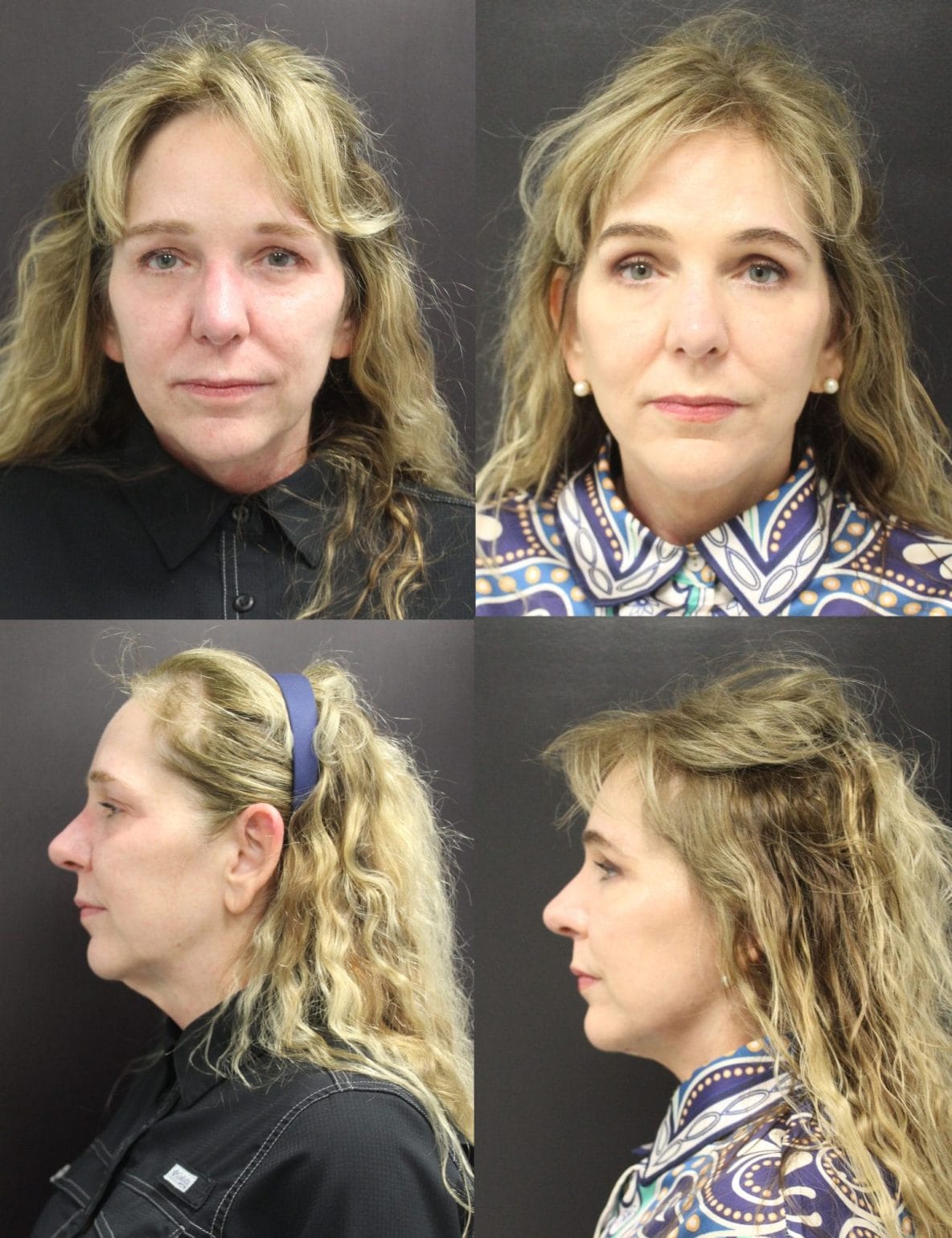 Face and Neck Lift before and after by Dr. Thomassen in Fort Lauderdale