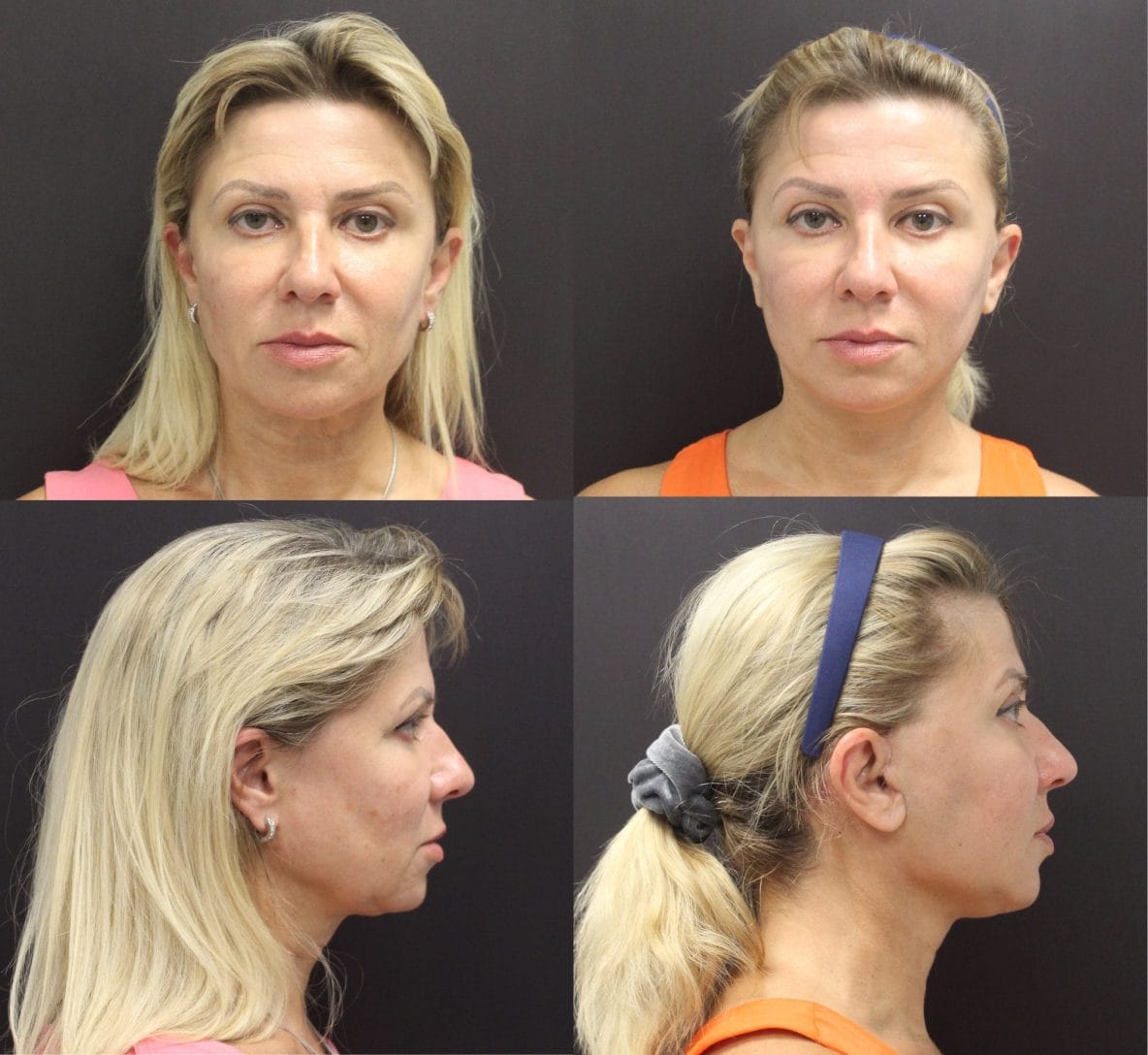 min facelift before and after by Dr. Thomassen in Fort Lauderdale