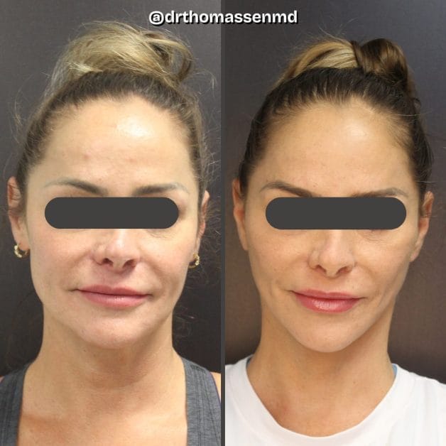 facelift1