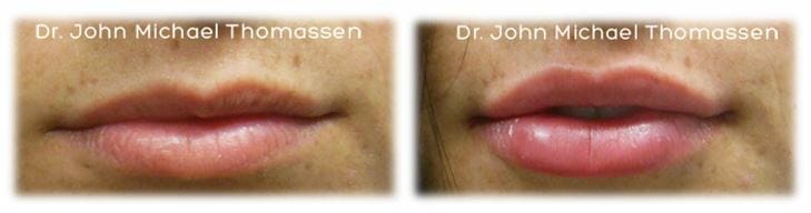 lip filler4 Lip Augmentation by Dr. Thomassen