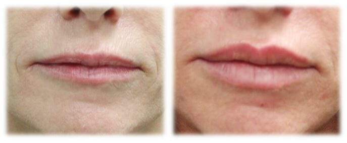 lip filler5 Lip Augmentation by Dr. Thomassen