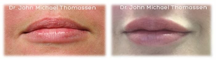 lip filler7 Lip Augmentation by Dr. Thomassen