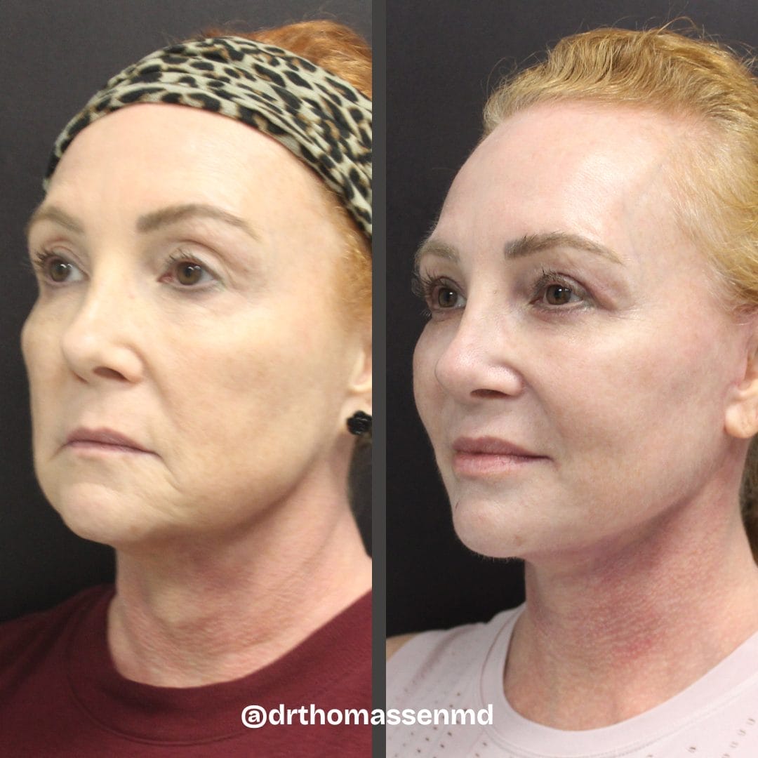 Facelift 7 Face and Neck Lift, Quad Bleph, Fat grafting by Dr. Thomassen in Fort Lauderdale