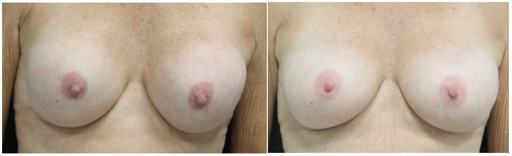 Removal of Hard Encapsulated Breast Implants and Replacement with New Implants | Fort Lauderdale | Dr. Thomassen