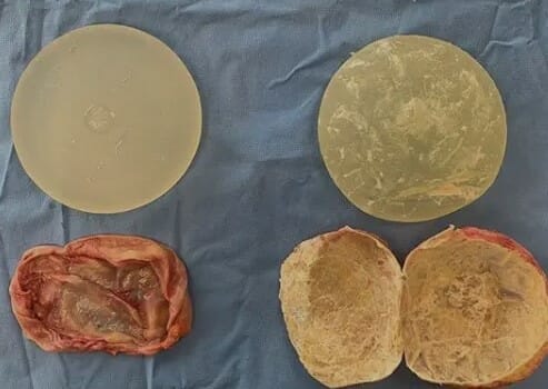 Breast Implant For Breast Augmentation Fort Lauderdale