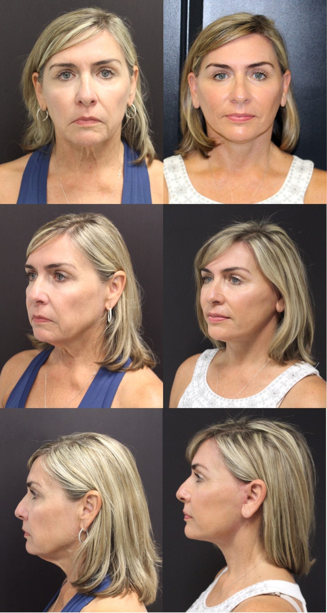 facelift 12 facelift before and after fort lauderdale