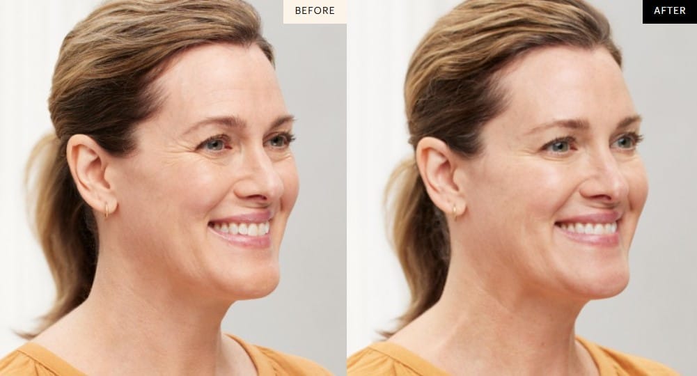 Circumferential Abdominoplasty by Dr. Thomassen in Fort Lauderdale