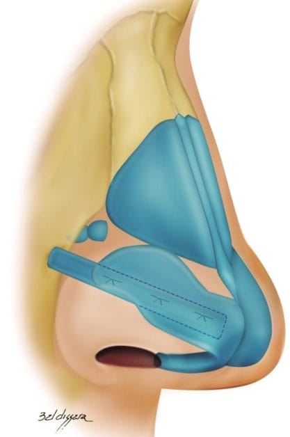 Lateral crural strut graft diagram