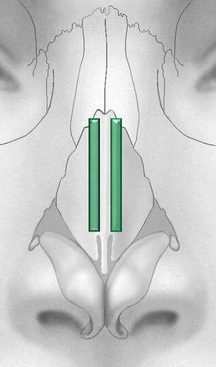 Spreader grafts to improve obstruction in internal nasal valves