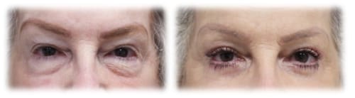 Upper Lid Blepharoplasty and Transconjunctival Lower Lid Bleph with Skin Excision