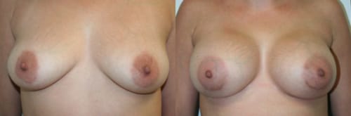 Breast Augmentation Before After 