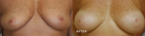 Breast Augmentation Before After 