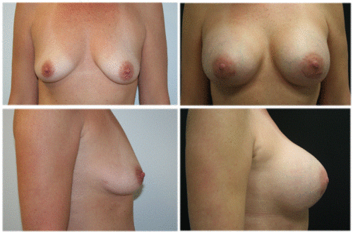45 year old female status post dual plane via areola approach breast augmentation surgery with high profile 380cc silicone implants. 4 weeks post op.Individual results may vary.