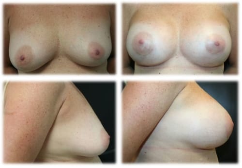 39 y/o female following breast augmentation with 400 cc High Profile Silicone gel implants. Individual results may vary. 