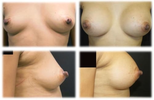 36 y/o female following breast augmentation with 325 cc Moderate Profile Plus Saline Implants filled to 360 cc.  Individual results may vary