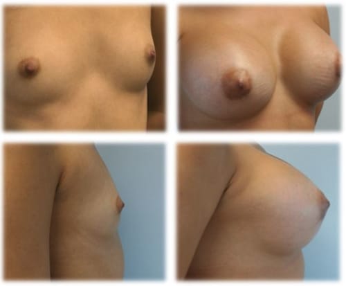 26 y/o female following breast augmentation with Saline Filled Breast Implants.  Individual results may vary.  