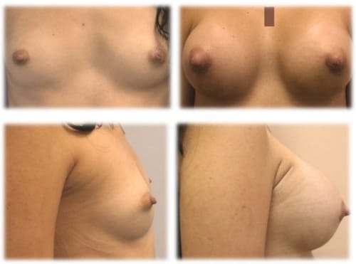 26 y/o female following breast augmentation. Individual results may vary. 