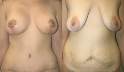 Breast Lift Before After 10a
