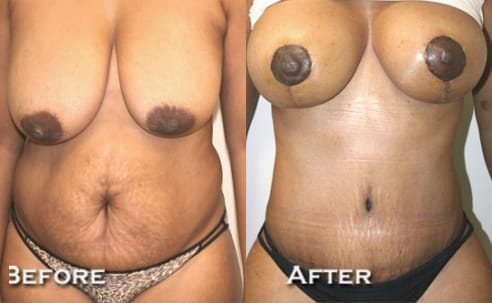 Breast Lift Before After 11a