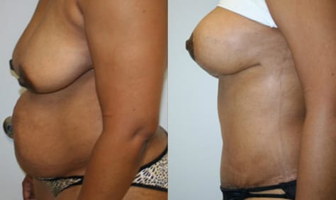 Breast Lift Before After 11b