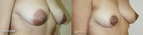Breast Lift Before After 17a