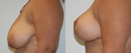 Breast Lift Before After 18b