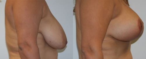 Breast Lift Before After 18c