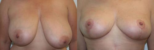 Breast Lift Before After 19a