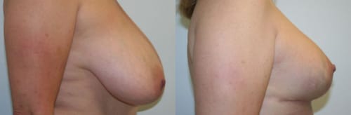 Breast Lift Before After 19b