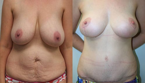 Breast Lift and Abdominoplasty