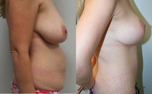 Breast Lift Before After 1b