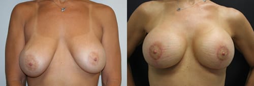 Breast Lift Before After 21a
