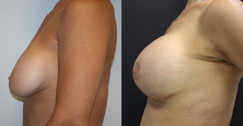 Breast Lift Before After 21b