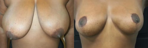 Breast Lift Before After 22a