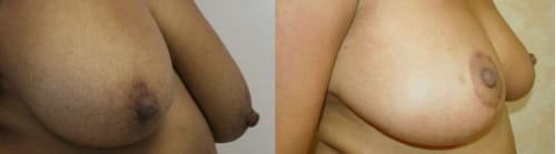 Breast Lift Before After 2a