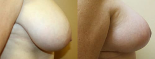 Breast Lift Before After 4a