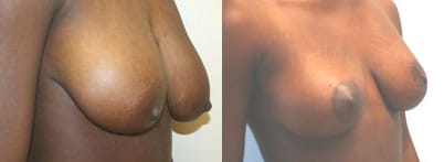 Breast Lift Before After 5a